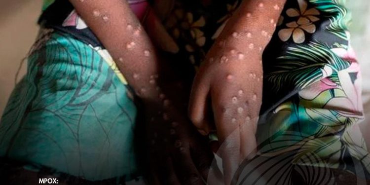 Casos de “Varíola” em África preocupa OMS