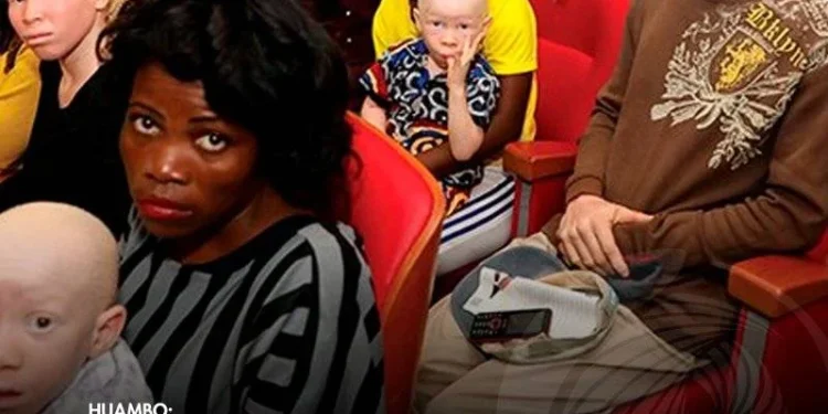 Mais de 35 pessoas com albinismo beneficiam de kits de protecção solar